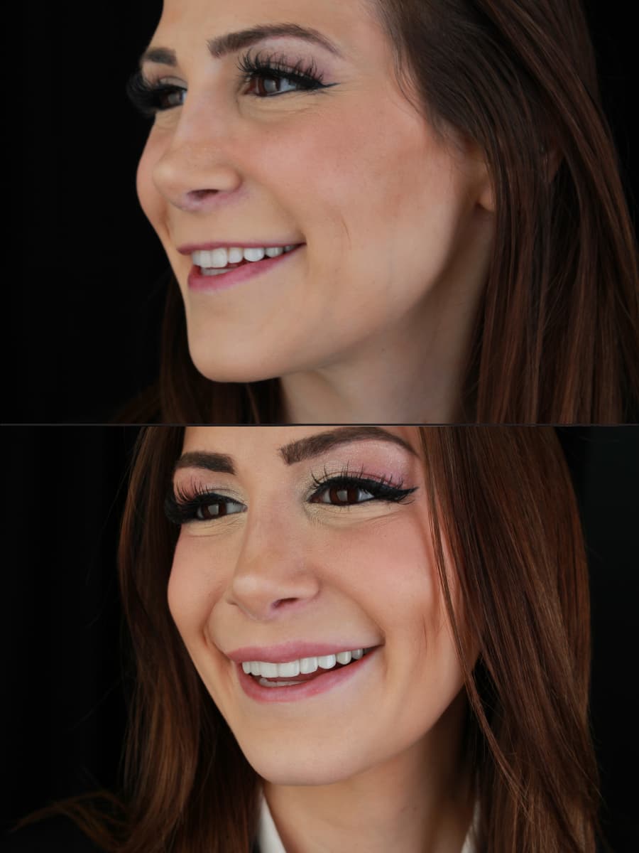 Portrait of a RealVeneers patient