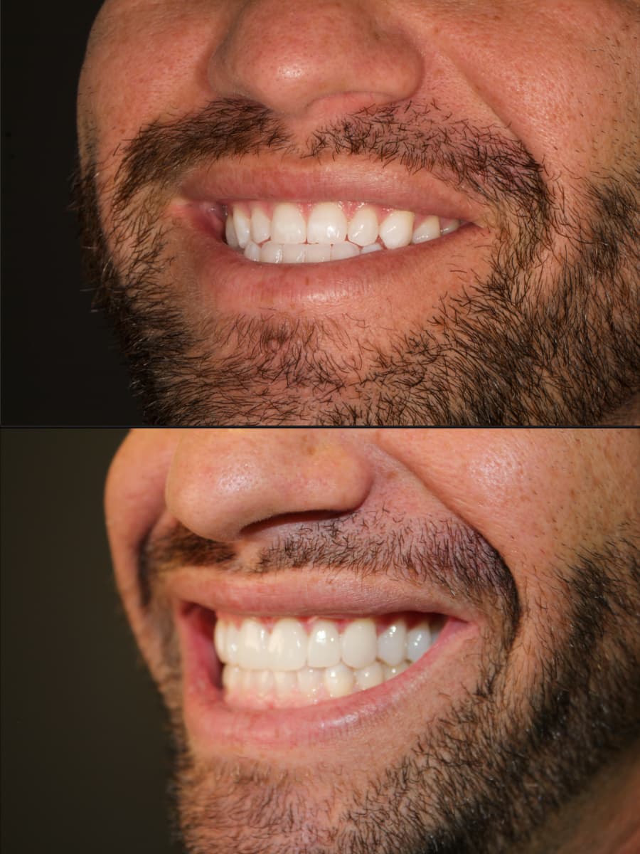 Rich — veneer result 3